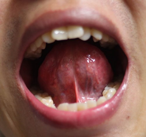 舌苔3.jpg