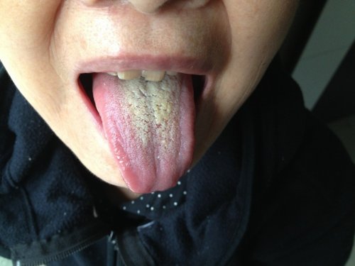 舌苔.jpg