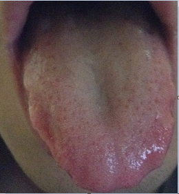 舌苔.png
