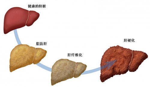脂肪肝1.jpg